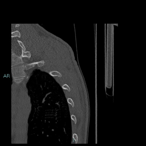 Avascular necrosis after fracture dislocations of the proximal humerus (Radiopaedia 88078-104655 Sagittal bone window 94).jpg