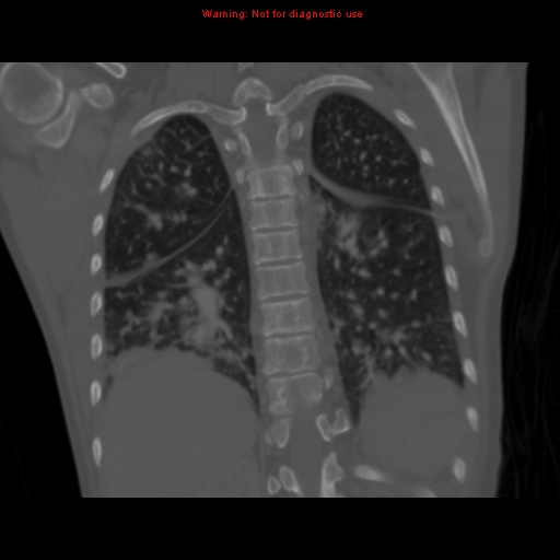 File:Avascular necrosis in sickle cell disease (Radiopaedia 17448-17152 Coronal bone window 93).jpg