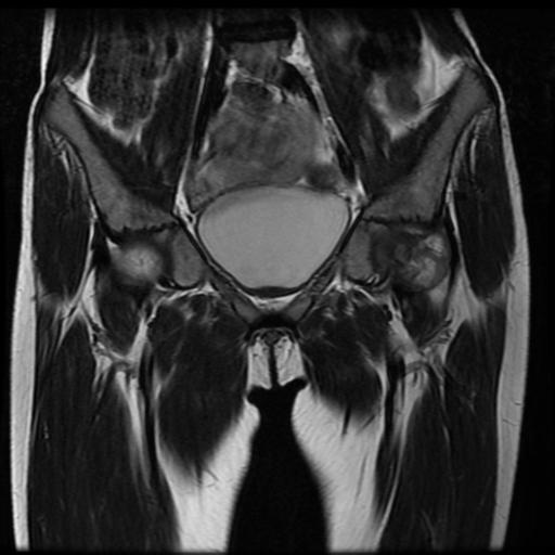 File:Avascular necrosis of the hip (Radiopaedia 29563-30067 Coronal T2 4).jpg