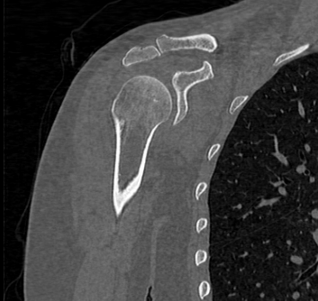 Avulsion fracture - greater tuberosity of humerus (Radiopaedia 71216-81514 Coronal bone window 27).jpg