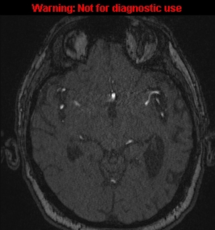 Azygos anterior cerebral artery (Radiopaedia 59325-66677 Axial MRA 74).jpg