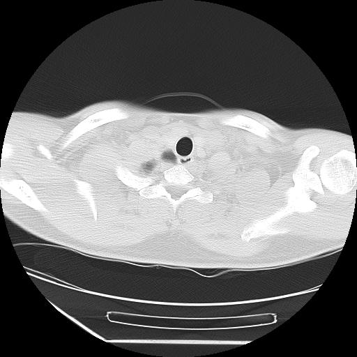 Azygos fissure (Radiopaedia 88181-104784 Axial lung window 1).jpg