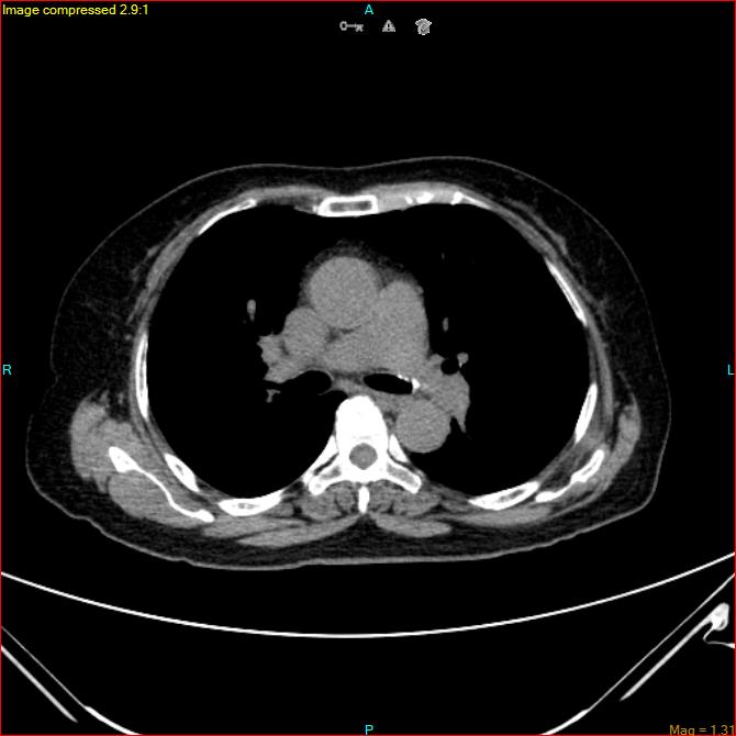 Azygos vein aneurysm (Radiopaedia 77824-90130 A 28).jpg