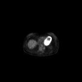 B-cell lymphoma of the mesentery (Radiopaedia 65743-74868 18F-FDG PET-CT 184).jpg
