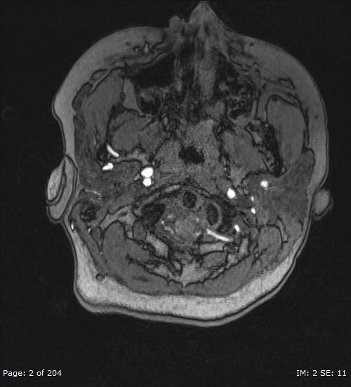 Balo concentric sclerosis (Radiopaedia 61637-69636 Axial MRA 2).jpg