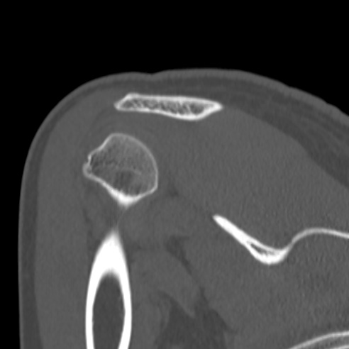 Bankart lesion (Radiopaedia 57256-64185 Coronal bone window 35).jpg