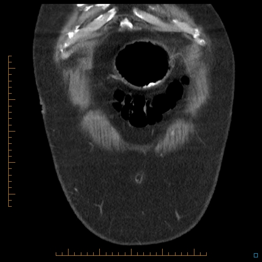 Bariatric balloon causing gastric outlet obstruction (Radiopaedia 54449-60672 B 3).jpg