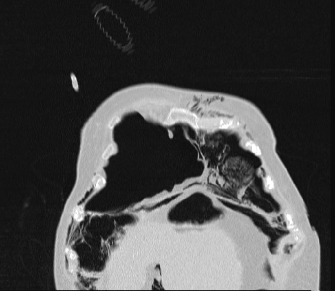 Barotrauma due to mechanical ventilation (Radiopaedia 28079-28336 Coronal lung window 15).jpg