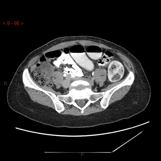 File:Bartholin gland cyst (Radiopaedia 54904-61181 Axial C+ delayed 24).jpg