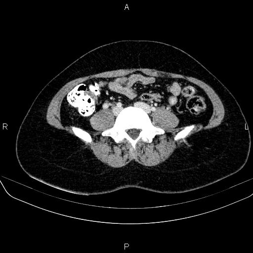 File:Bartholin gland cyst (Radiopaedia 62635-70930 Axial Post contrast 2).jpg