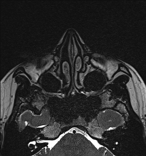 File:Basal cell carcinoma - nasal region (Radiopaedia 70292-80365 Axial Gradient Echo 44).jpg