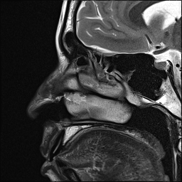 File:Basal cell carcinoma - nasal region (Radiopaedia 70292-80365 Sagittal T2 11).jpg