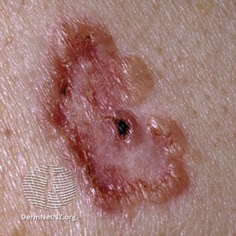 Basal cell carcinoma affecting the face (DermNet NZ lesions-bcc-face-0624).jpg