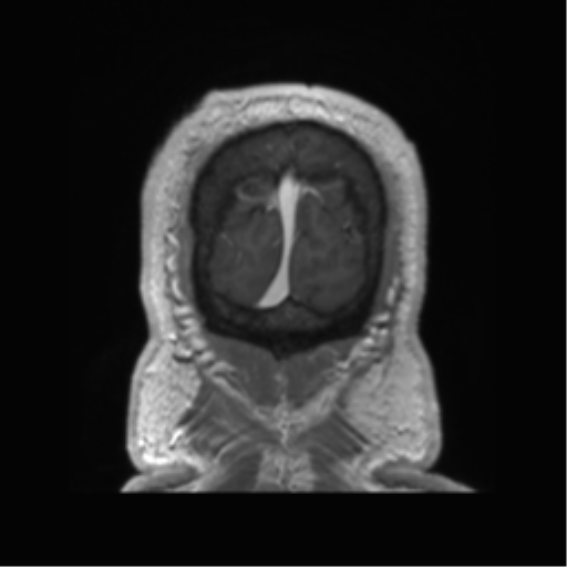 Basal ganglia hemorrhage - hypertensive (Radiopaedia 42227-45303 Coronal T1 C+ 16).png