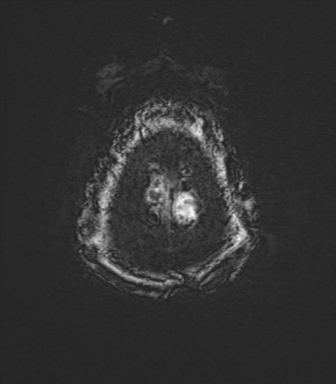 Basal ganglia metastasis (Radiopaedia 78928-91828 Axial SWI 87).png