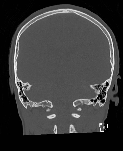 Base of skull fracture with bilateral Le Fort fractures (Radiopaedia 47094-51638 Coronal bone window 34).jpg