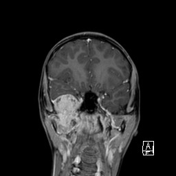 Base of skull rhabdomyosarcoma (Radiopaedia 32196-33142 I 30).jpg