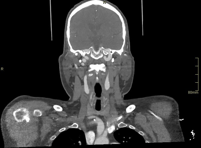 File:Basilar artery aneurysm (Radiopaedia 56261-62932 B 19).jpg