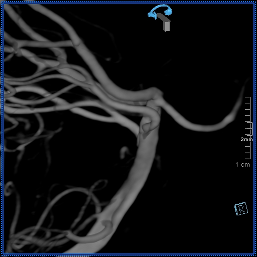 Basilar artery perforator aneurysm (Radiopaedia 82455-99524 3D Left VA 67).jpg