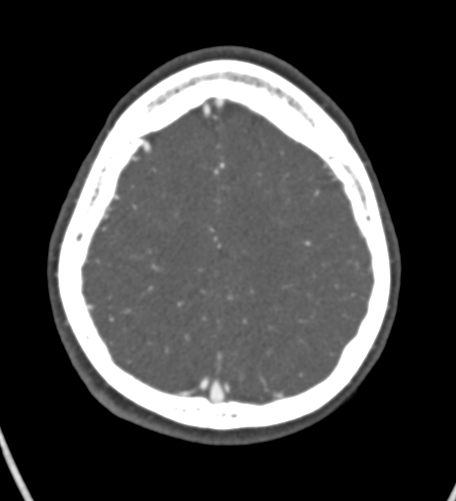 Basilar tip aneurysm with coiling (Radiopaedia 53912-60086 A 120).jpg