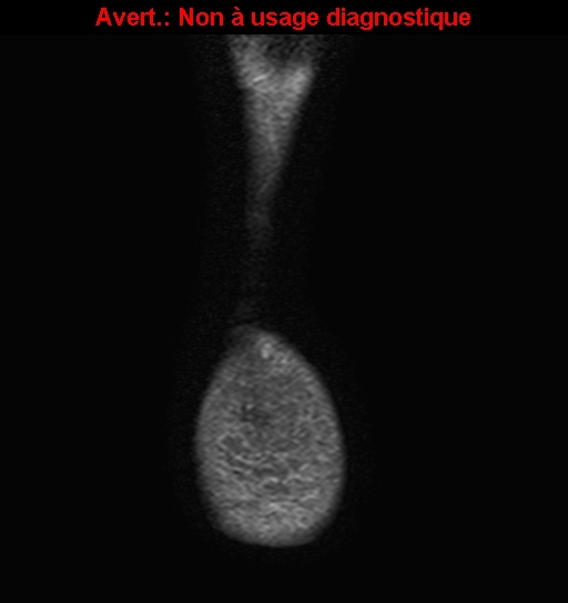 File:Baxter neuropathy (Radiopaedia 25988-26124 Coronal T2 fat sat 21).jpg