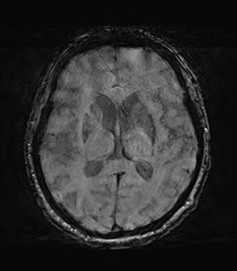 File:Behavioral variant frontotemporal dementia and late onset schizophrenia (Radiopaedia 52197-58083 Axial SWI 40).png