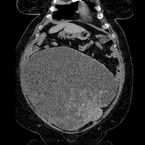 Benign leiomyoma with hydropic features (Radiopaedia 89250-106130 B 43).jpg