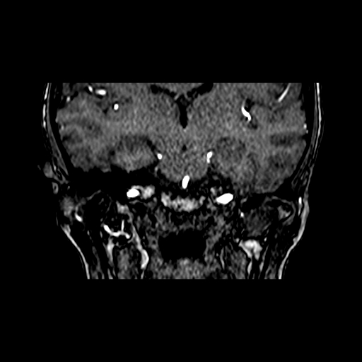 File:Berry aneurysm of the terminal internal carotid artery (Radiopaedia 88286-104918 Coronal TOF 54).jpg