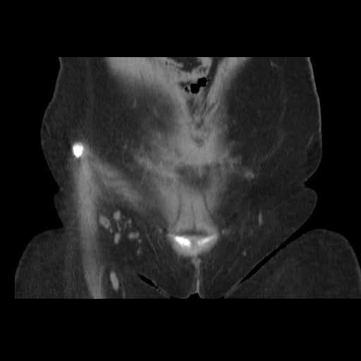File:Bicornuate uterus- on MRI (Radiopaedia 49206-54296 Coronal non-contrast 1).jpg