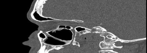 Bilateral Ectopic Infraorbital Nerves (Radiopaedia 49006-54084 Sagittal bone window 32).jpg