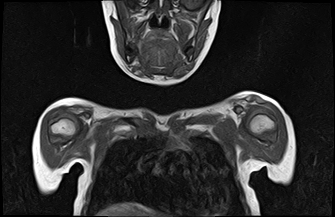 File:Bilateral Sprengel deformity with Klippel-Feil syndrome (Radiopaedia 66395-75650 Coronal T1 5).jpg