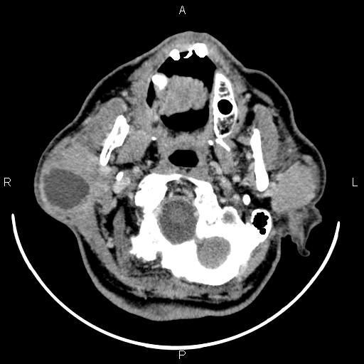 Bilateral Warthin tumors (Radiopaedia 84034-99263 Axial With contrast 17).jpg