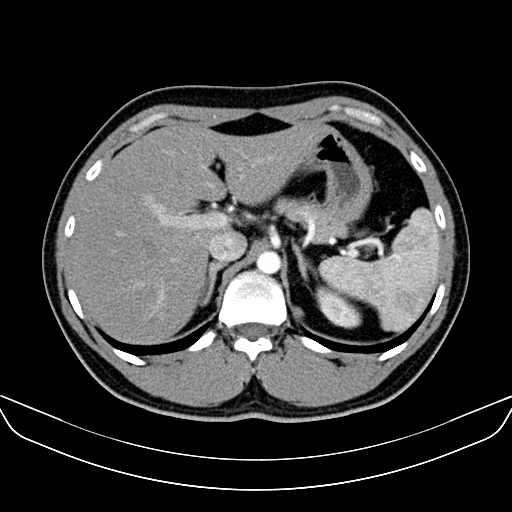Bilateral accessory renal arteries with mild pelvi-ureteric junction (PUJ) obstruction (Radiopaedia 66357-75596 A 11).jpg