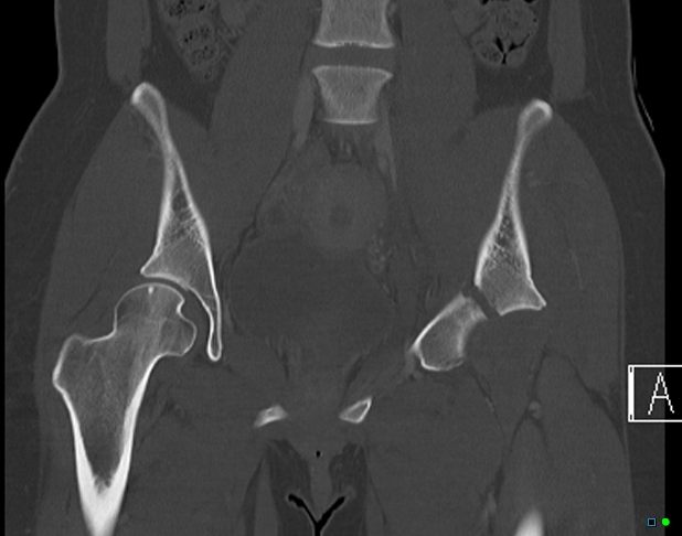 File:Bilateral acetabular fractures (Radiopaedia 79272-92308 Coronal bone window 17).jpg