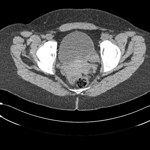 File:Bilateral acetabular protrusion with pincer type femoro-acetabular impingement (Radiopaedia 30134-30733 AXIAL SOFT THIN 36).jpg