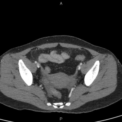 File:Bilateral adrenal gland hyperenhancement in pancreatitis (Radiopaedia 86642-102753 E 96).jpg
