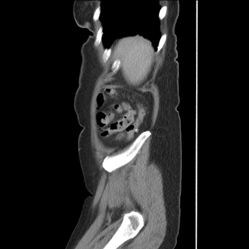 Bilateral adrenal granulocytic sarcomas (chloromas) (Radiopaedia 78375-91007 C 119).jpg