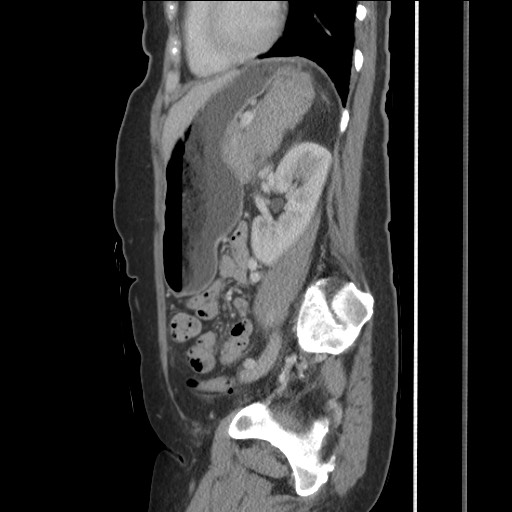 Bilateral adrenal granulocytic sarcomas (chloromas) (Radiopaedia 78375-91007 C 93).jpg