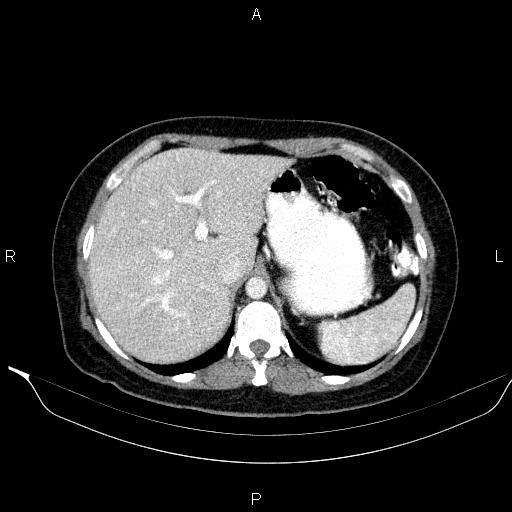File:Bilateral adrenal myelolipoma (Radiopaedia 63058-71535 B 34).jpg