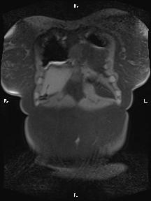 Bilateral adrenal myelolipoma (Radiopaedia 63058-71537 Coronal T1 fat sat 98).jpg