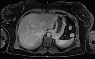 File:Bilateral adrenal myelolipoma (Radiopaedia 63058-71537 H 20).jpg