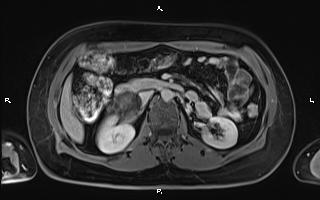 File:Bilateral adrenal myelolipoma (Radiopaedia 63058-71537 H 48).jpg