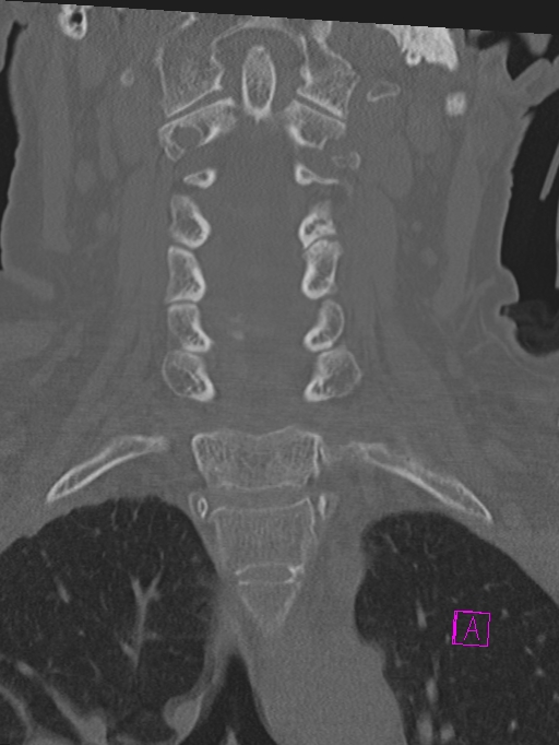 Bilateral atlanto-occipital assimilation (Radiopaedia 28350-28603 Coronal bone window 18).jpg