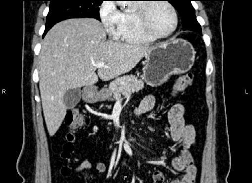 Bilateral benign adrenal adenomas (Radiopaedia 86912-103124 D 18).jpg