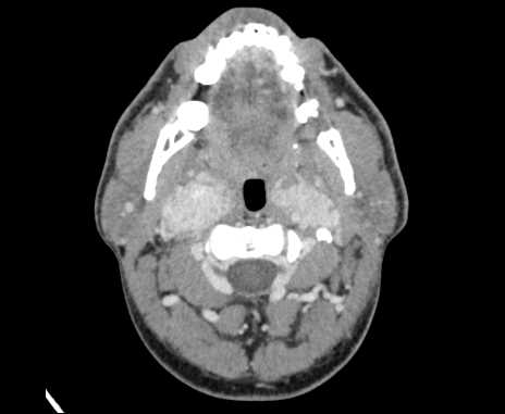 Bilateral carotid body tumors (Radiopaedia 61841-69870 Axial Post contrast 28).jpg