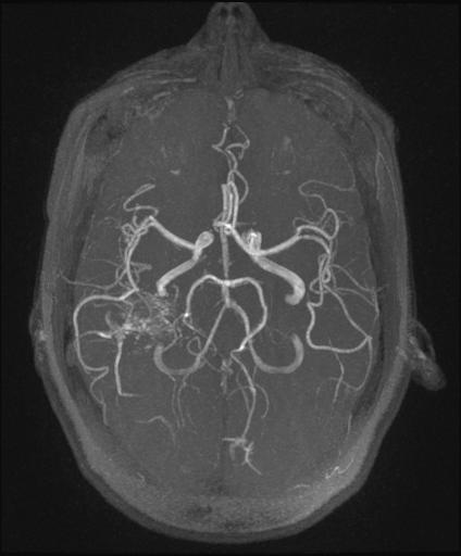 Bilateral carotid body tumors and right glomus jugulare tumor (Radiopaedia 20024-20060 Axial MRA 141).jpg