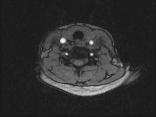 Bilateral carotid body tumors and right glomus jugulare tumor (Radiopaedia 20024-20060 Axial MRA 216).jpg