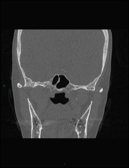 Bilateral frontal mucoceles (Radiopaedia 82352-96454 Coronal 237).jpg