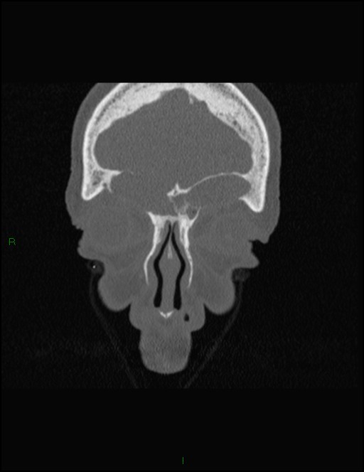 Bilateral frontal mucoceles (Radiopaedia 82352-96454 Coronal 71).jpg
