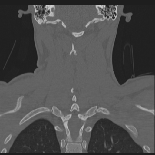 Bilateral locked facets (Radiopaedia 33850-35016 Coronal bone window 64).png